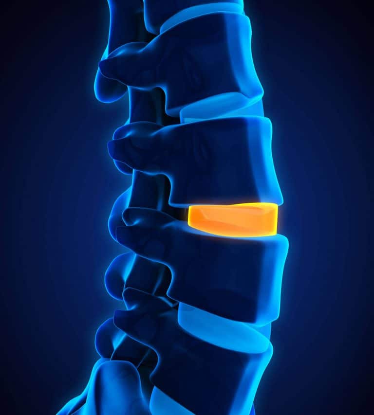 Back in Motion with Stem Cell Therapy for Degenerative Disc Disease ...