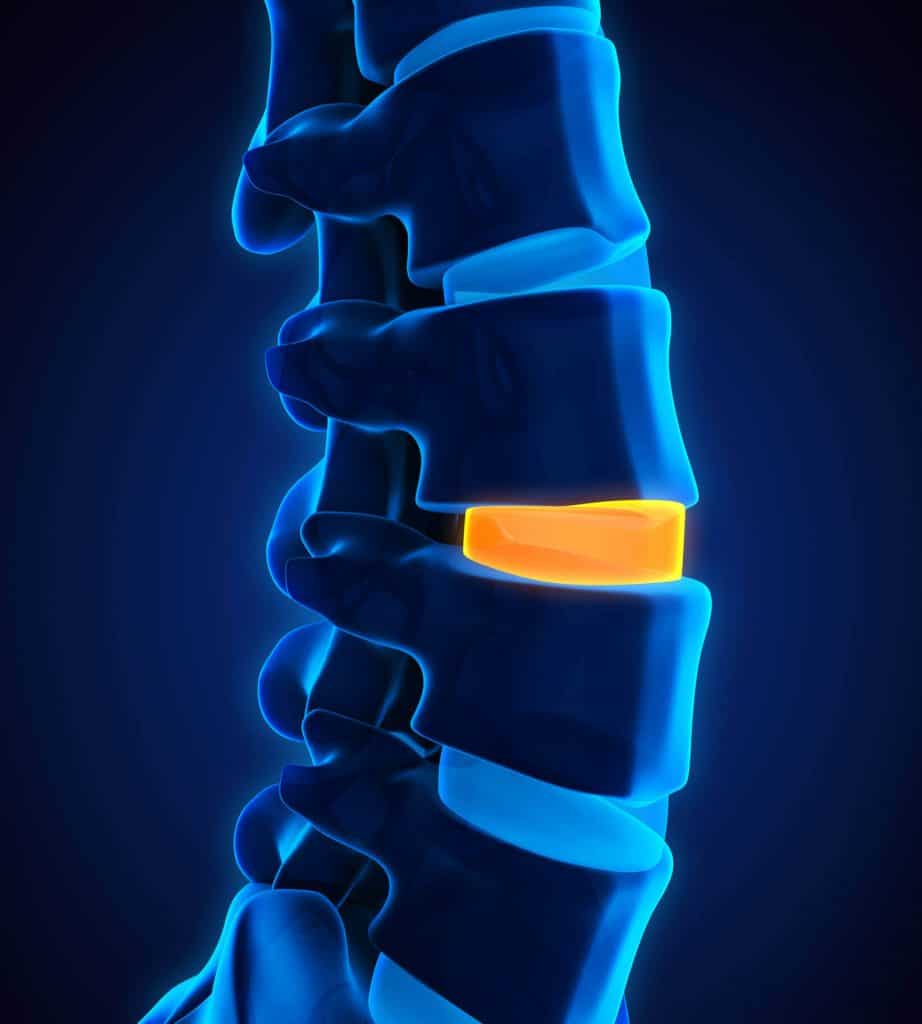 Stem Cell Therapy for Degenerative Disc Disease