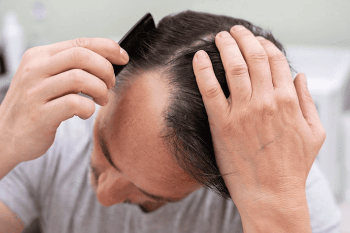 exosomes for hair loss in Tijuana 2