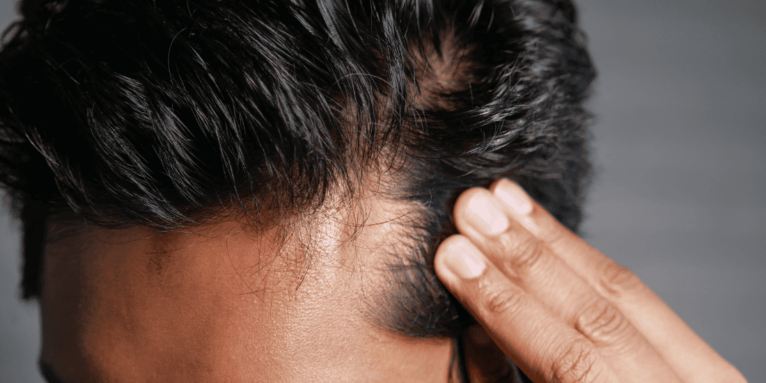 exosomes for hair loss in Tijuana