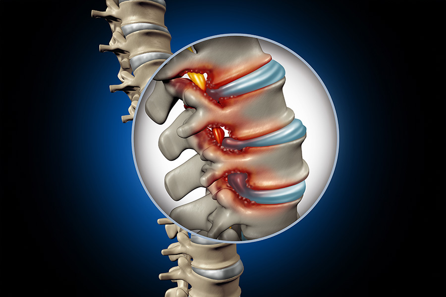 stem cell therapy for spinal stenosis 2