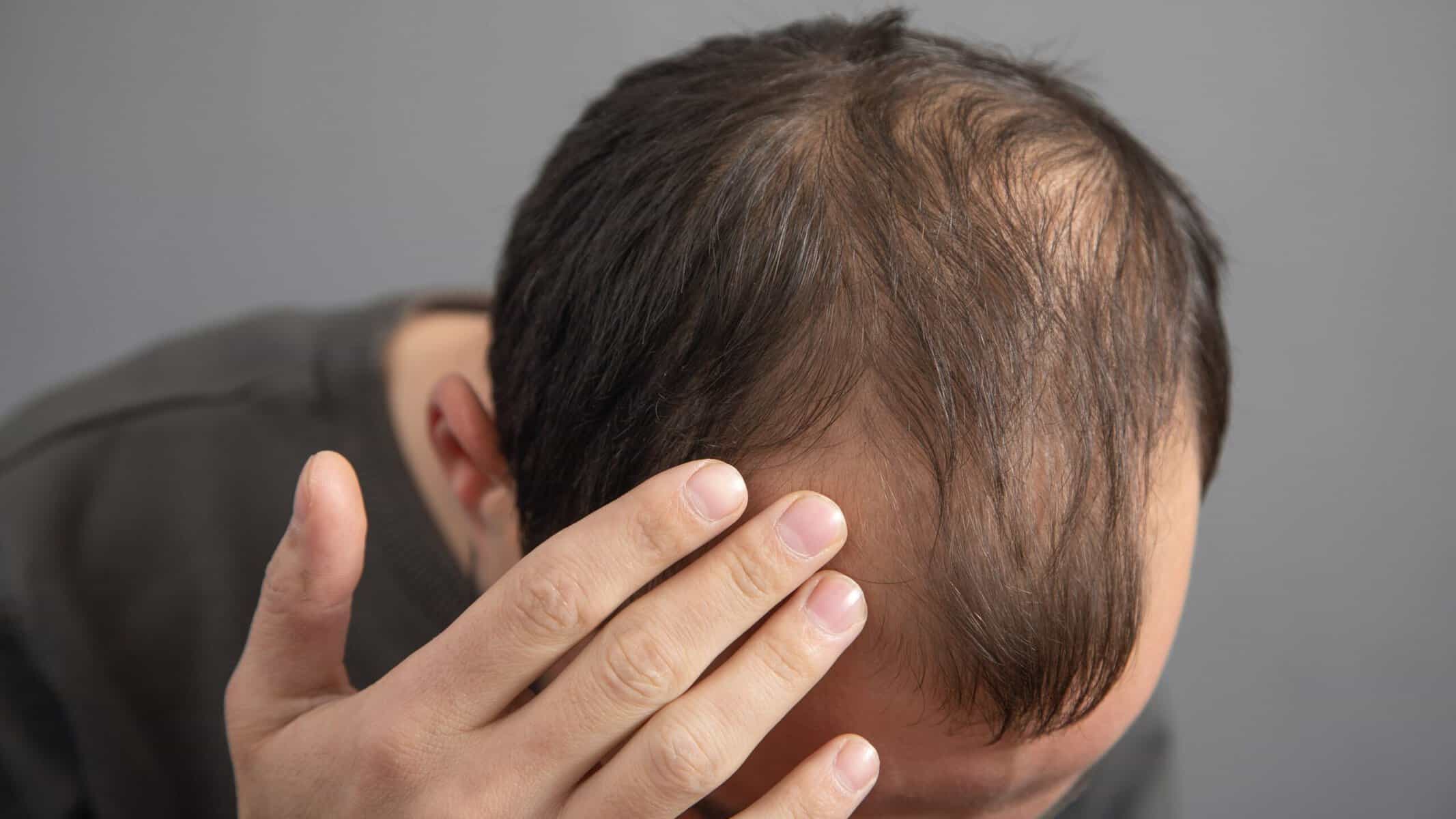 Close-up of a man examining his thinning hair and scalp, highlighting hair loss issues.