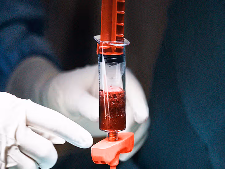 stem cell therapy rheumatoid arthritis